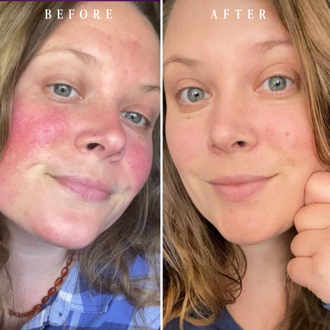 Clear Skin System for Breakouts & Blemishes