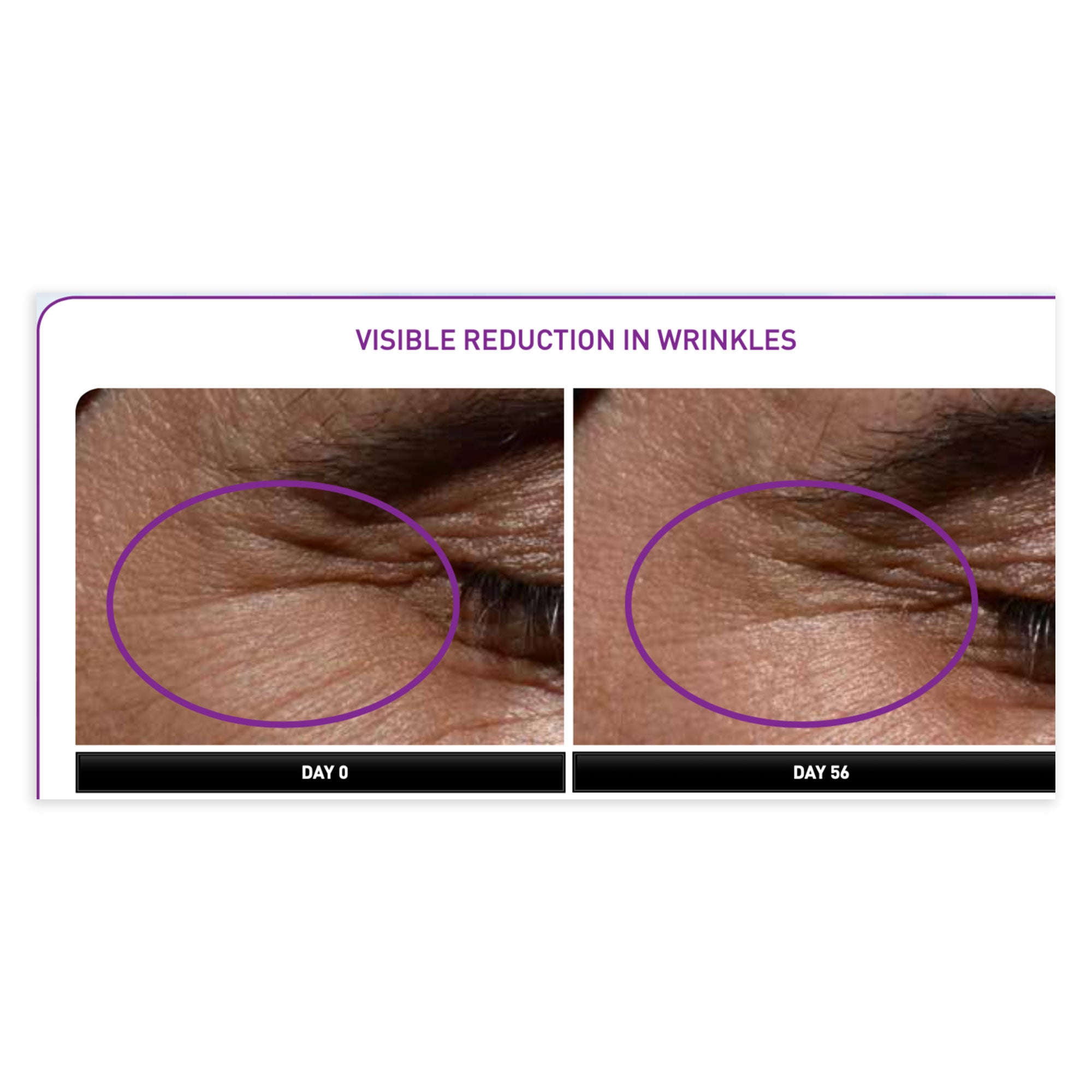 Before and after comparison of wrinkles on skin with visible reduction.