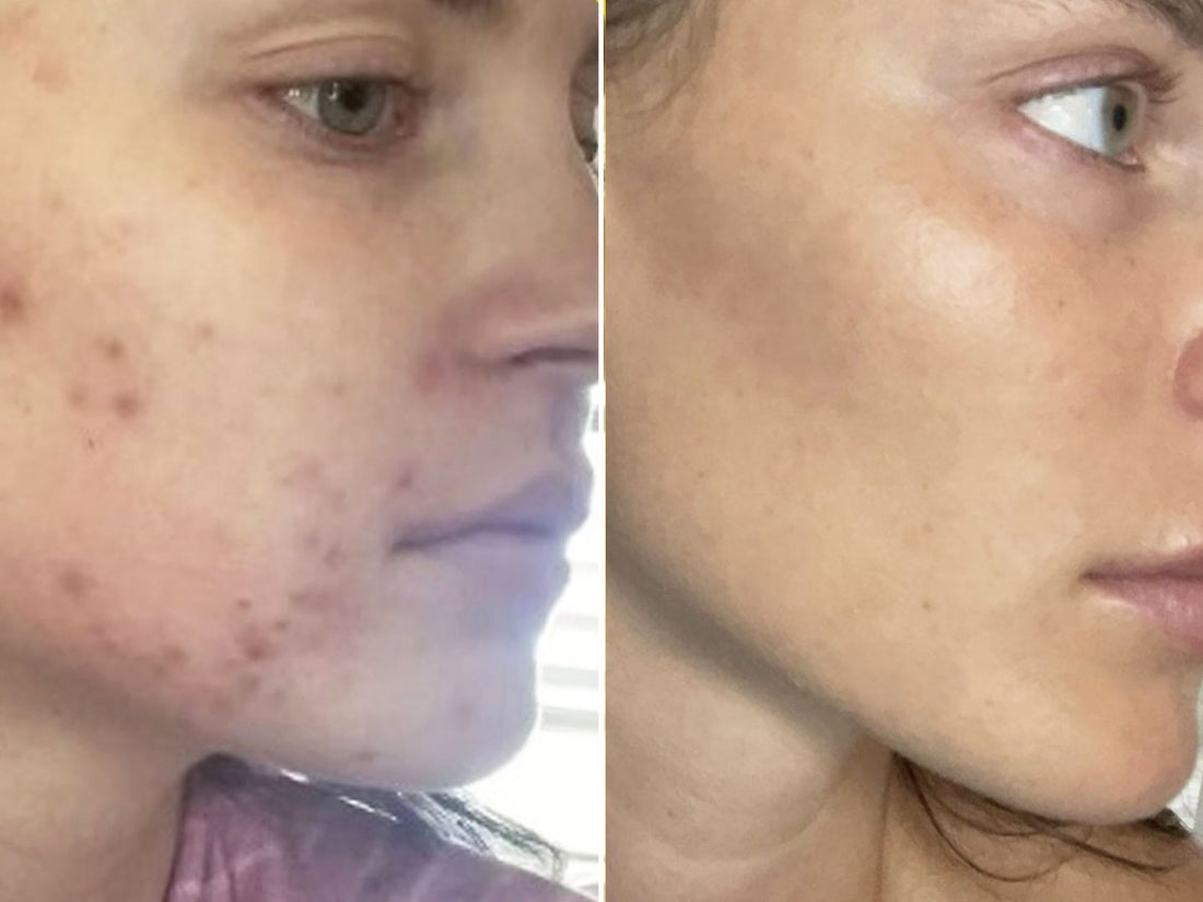 Clear Skin System for Breakouts &amp; Blemishes