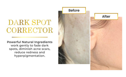 Brightening System for Dark Spots &amp; Hyperpigmentation