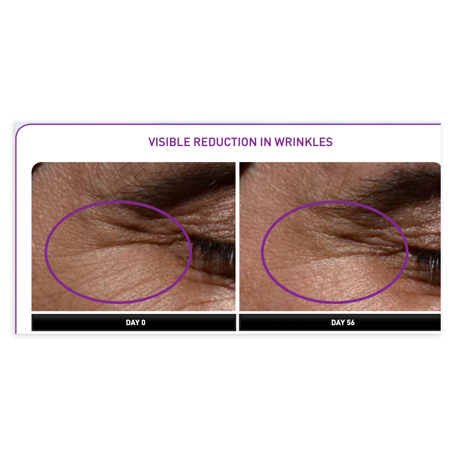 Before and after comparison of wrinkles on skin with visible reduction.