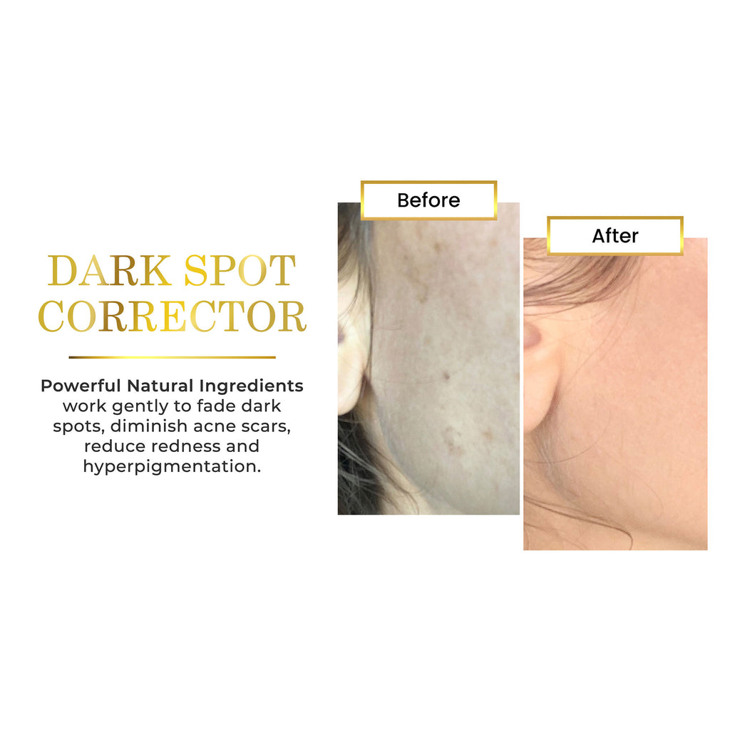 Before and after comparison of dark spot corrector on skin with text about Luxe Beauty Lighten & Brighten Serum  benefits.